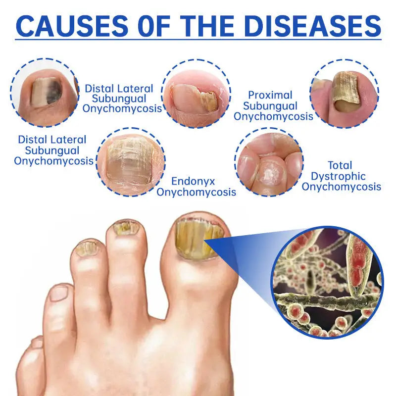 Dispositivo de terapia con láser para hongos