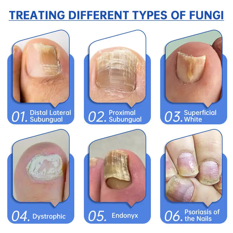 Dispositivo de terapia con láser para hongos